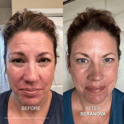 Seranova The Micro Infusion System