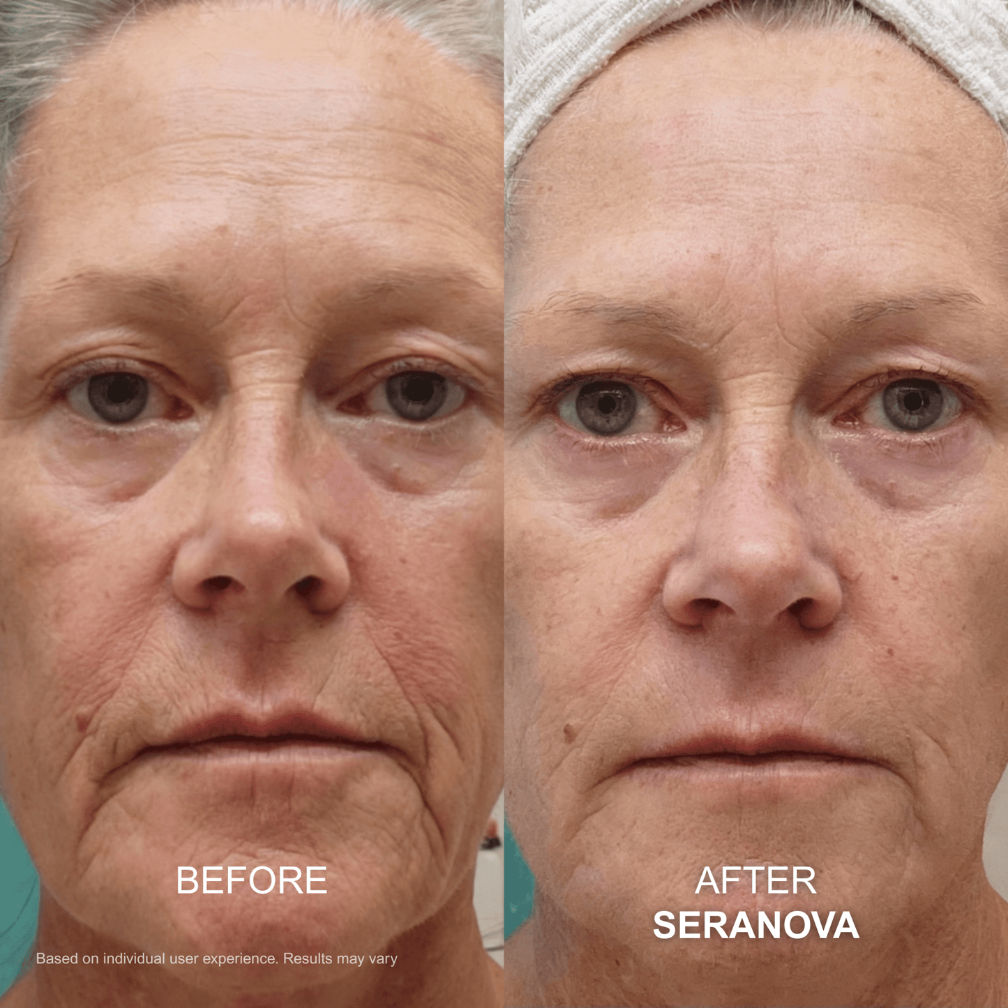 Seranova The Micro Infusion System